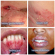 Illustration for article titled ibagaimana cara mengobati herpes sampai tuntasem/em/i